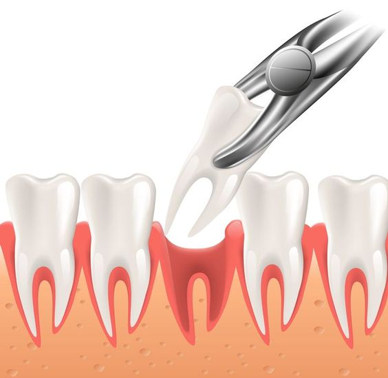 علت درد دندان کشیده شده
